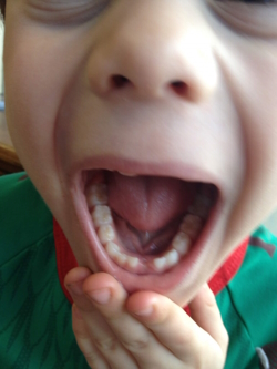 A young boy opens his mouth to show his first missing tooth